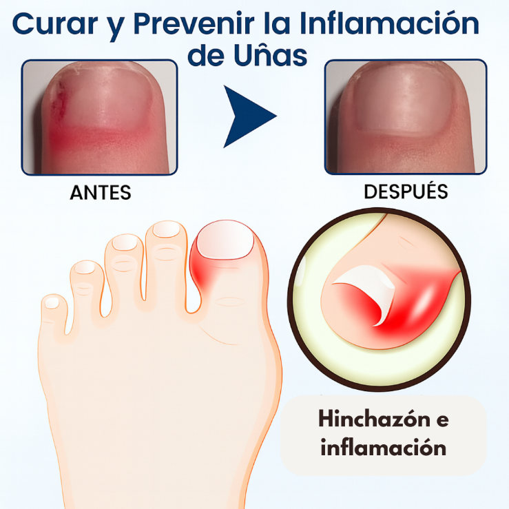Oferta 2X1 Timilk - OnyxiGuard Spray Herbal de Reparación Fúngica| El secreto natural para uñas sanas y atractivas.