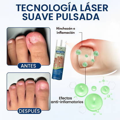Oferta 2X1 Timilk - OnyxiGuard Spray Herbal de Reparación Fúngica| El secreto natural para uñas sanas y atractivas.