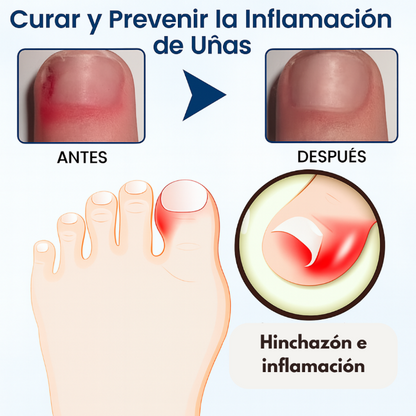Oferta 2X1 Timilk - OnyxiGuard Spray Herbal de Reparación Fúngica| El secreto natural para uñas sanas y atractivas.